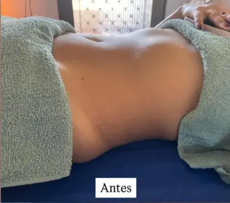 Antes — Drenagem linfática pós-operatória