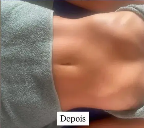 Depois - Massagem Modeladora